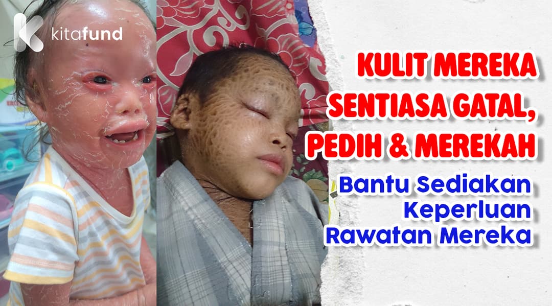 PENYAKIT KULIT INI MENYEBABKAN MEREKA MENAHAN SAKIT SETIAP HARI, BANTU MEREKA MENDAPATKAN PENJAGAAN BERTERUSAN