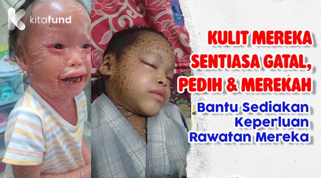 PENYAKIT KULIT INI MENYEBABKAN MEREKA MENAHAN SAKIT SETIAP HARI, BANTU MEREKA MENDAPATKAN PENJAGAAN BERTERUSAN