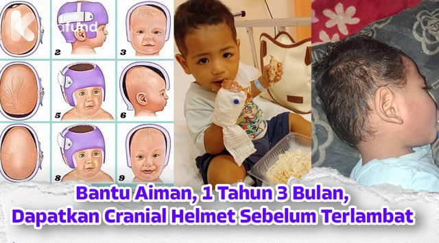 Dana Kasih Aiman - Helmet Khas Untuk Rawat Masalah Kepala Rata